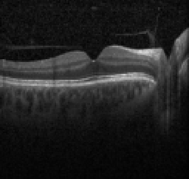 oct macula study, the diagnosis is hidden until you answer