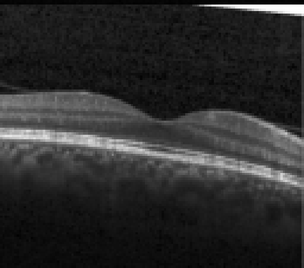 oct macula study, the diagnosis is hidden until you answer
