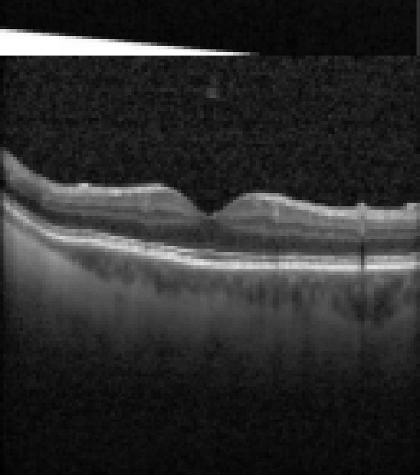 oct macula study, the diagnosis is hidden until you answer