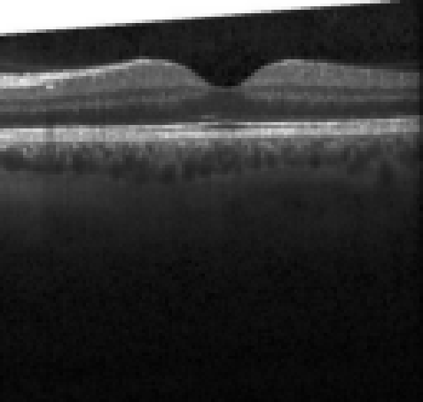 oct macula study, the diagnosis is hidden until you answer