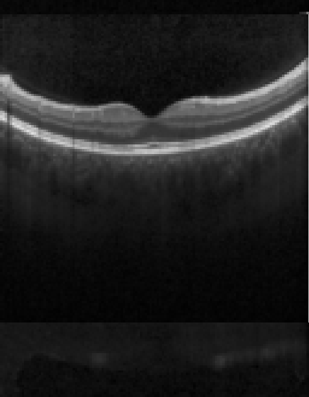 oct macula study, the diagnosis is hidden until you answer