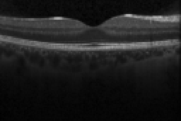 oct macula study, the diagnosis is hidden until you answer