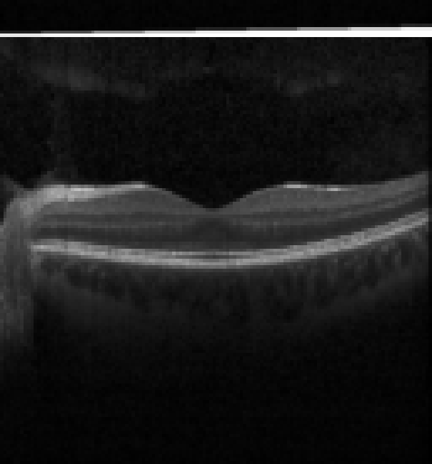 oct macula study, the diagnosis is hidden until you answer