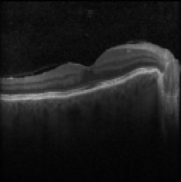 oct macula study, the diagnosis is hidden until you answer