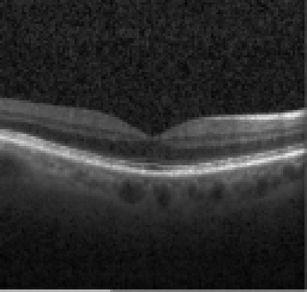 oct macula study, the diagnosis is hidden until you answer