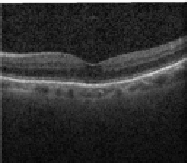 oct macula study, the diagnosis is hidden until you answer