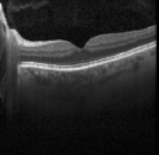oct macula study, the diagnosis is hidden until you answer