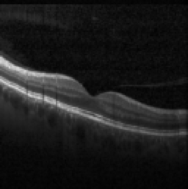 oct macula study, the diagnosis is hidden until you answer