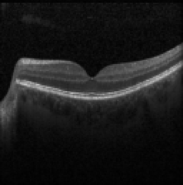 oct macula study, the diagnosis is hidden until you answer