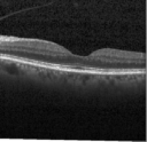 oct macula study, the diagnosis is hidden until you answer