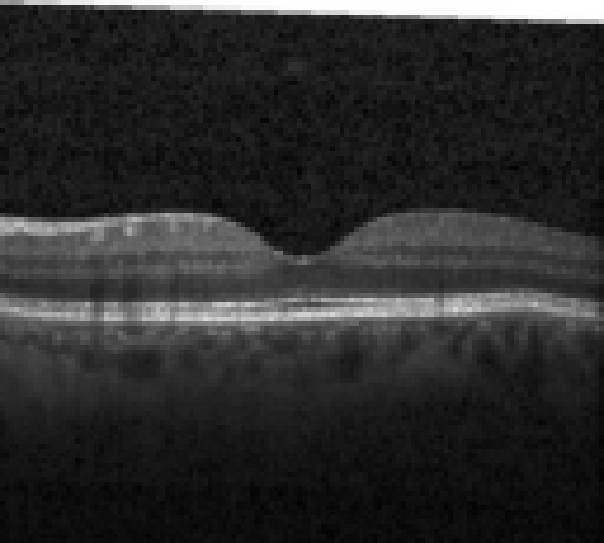 oct macula study, the diagnosis is hidden until you answer