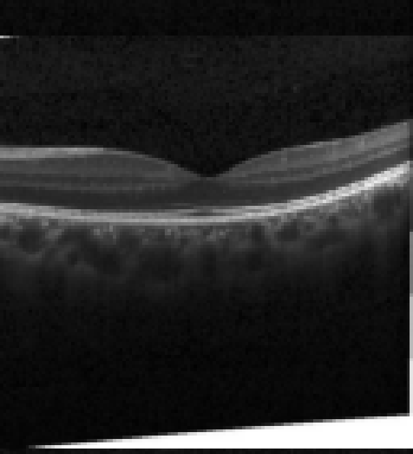 oct macula study, the diagnosis is hidden until you answer