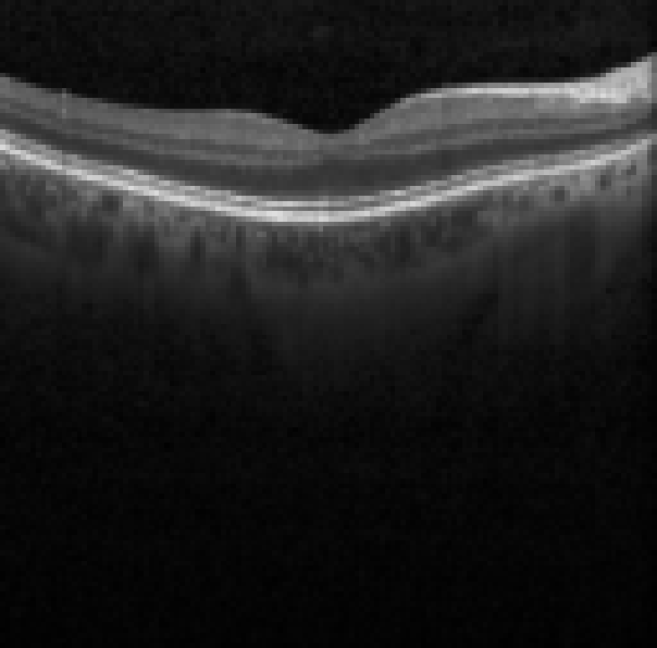 oct macula study, the diagnosis is hidden until you answer