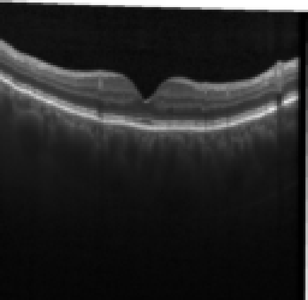 oct macula study, the diagnosis is hidden until you answer