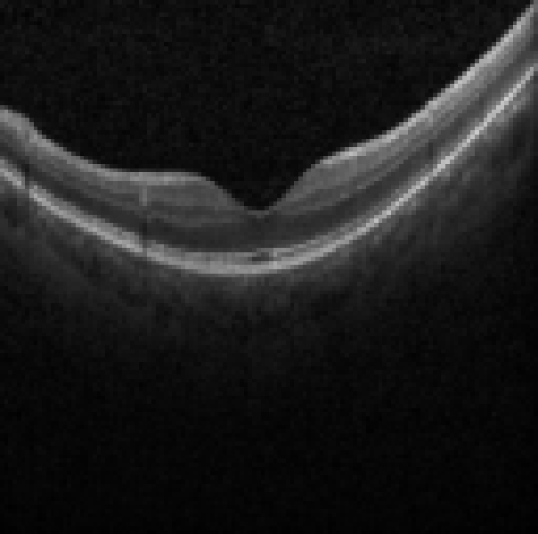 oct macula study, the diagnosis is hidden until you answer