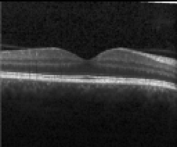 oct macula study, the diagnosis is hidden until you answer