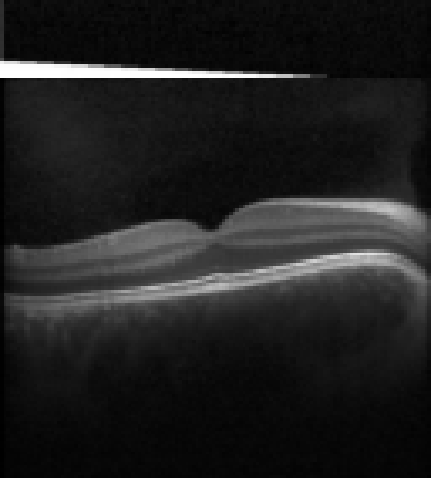 oct macula study, the diagnosis is hidden until you answer
