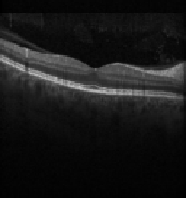 oct macula study, the diagnosis is hidden until you answer