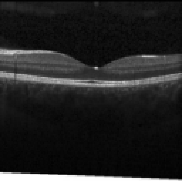 oct macula study, the diagnosis is hidden until you answer